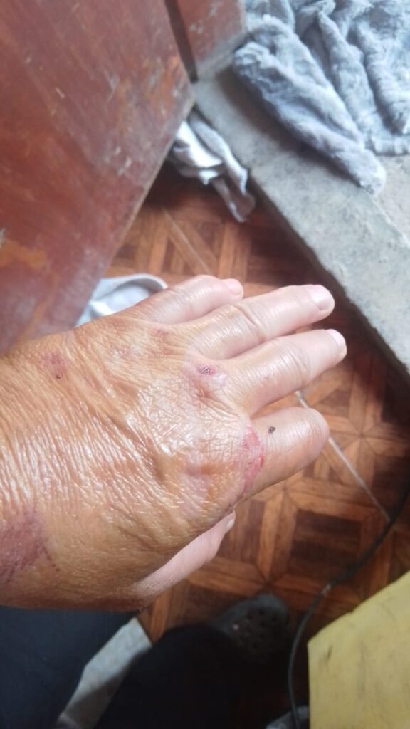 Vecina de La Donosa sufrió un accidente y su familia pide ayuda para su recuperación